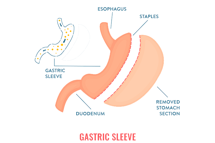 illustration for gastric sleeve in New Jersey